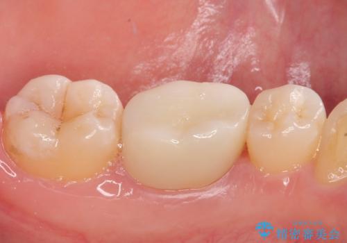 銀歯のところがしみる オールセラミッククラウンの治療後