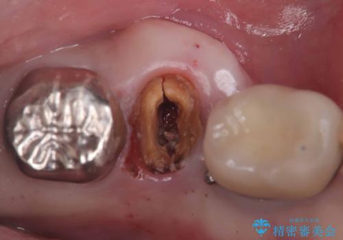 【1Dayインプラント治療! 低侵襲で短期間での治療】 咬むと歯が痛い! 歯根破折の症例 治療前