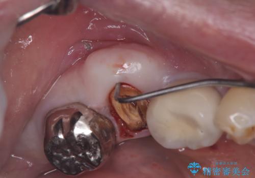 【1Dayインプラント治療! 低侵襲で短期間での治療】 咬むと歯が痛い! 歯根破折の治療前