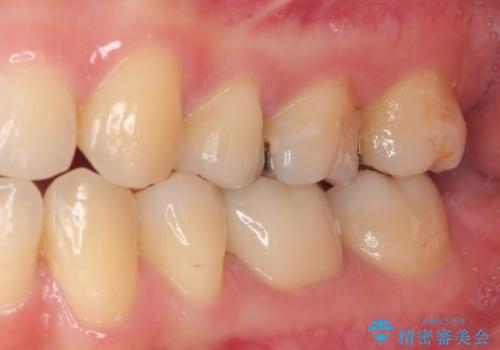 銀歯のところがしみる オールセラミッククラウンの治療後