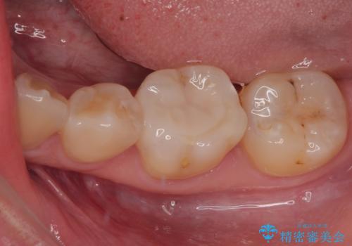 保険の白い詰め物が割れた　ハイブリッドインレーの症例 治療後