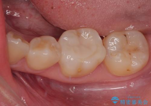 保険の白い詰め物が割れた ハイブリッドインレーの症例 治療後