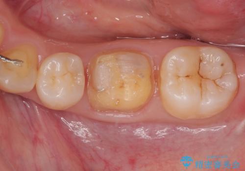 銀歯のところがしみる　オールセラミッククラウンの治療中