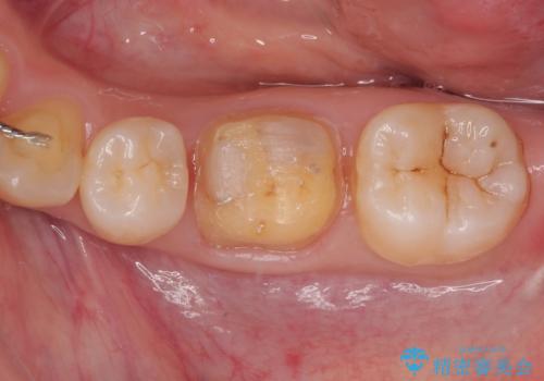 銀歯のところがしみる オールセラミッククラウンの治療中