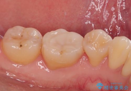 保険の白い詰め物が割れた ハイブリッドインレーの治療後