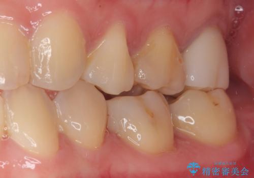 保険の白い詰め物が割れた ハイブリッドインレーの治療後