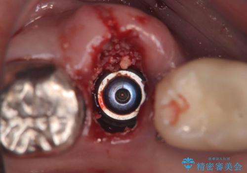 【1Dayインプラント治療! 低侵襲で短期間での治療】 咬むと歯が痛い! 歯根破折の治療中