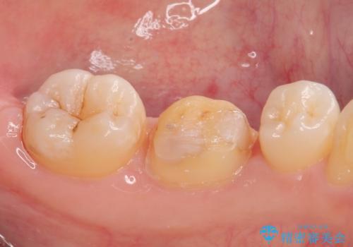 銀歯のところがしみる　オールセラミッククラウンの治療中