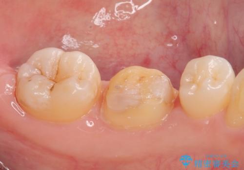銀歯のところがしみる オールセラミッククラウンの治療中