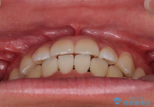 急速拡大装置 歯列弓を拡大して非抜歯ワイヤー矯正の治療後