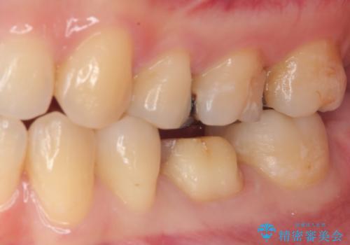 銀歯のところがしみる オールセラミッククラウンの治療中