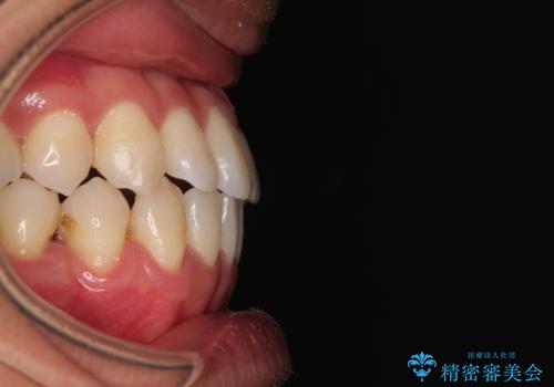 急速拡大装置 歯列弓を拡大して非抜歯ワイヤー矯正の治療後