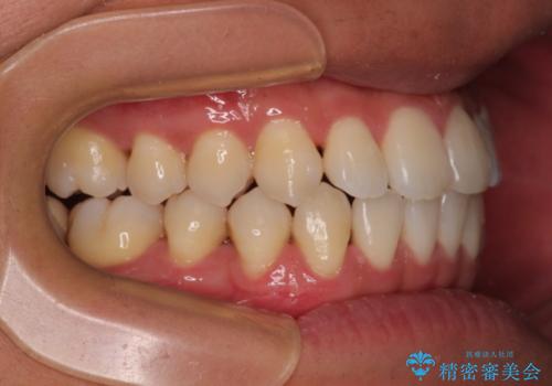 急速拡大装置 歯列弓を拡大して非抜歯ワイヤー矯正の治療後