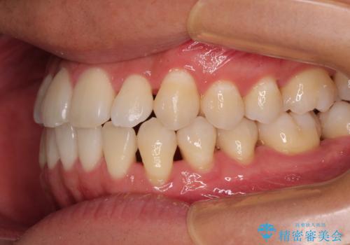 急速拡大装置 歯列弓を拡大して非抜歯ワイヤー矯正の治療後