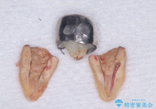 【1Dayインプラント治療! 低侵襲で短期間での治療】 咬むと歯が痛い! 歯根破折の治療中