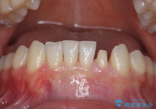下の前歯が欠けている セラミックで審美的に エアフローで着色除去もの治療中