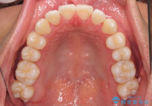 急速拡大装置 歯列弓を拡大して非抜歯ワイヤー矯正の治療後