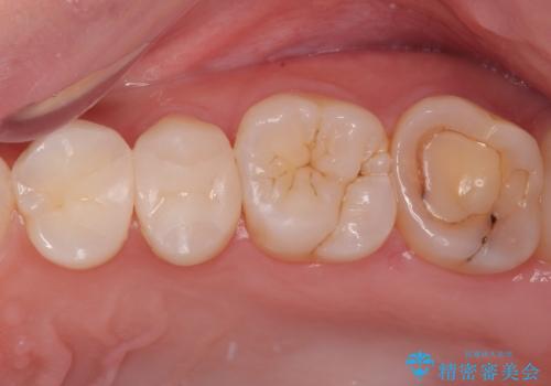 左上がしみて痛い　セラミックインレー修復の治療後