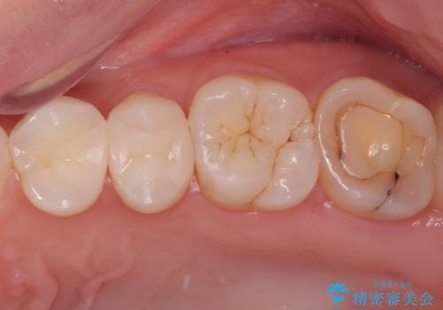 左上がしみて痛い セラミックインレー修復の症例 治療後