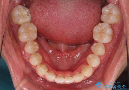 急速拡大装置 歯列弓を拡大して非抜歯ワイヤー矯正の治療後