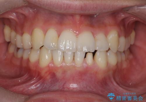 下の前歯が欠けている セラミックで審美的に エアフローで着色除去もの治療中