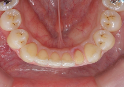 下の前歯が欠けている　セラミックで審美的に　エアフローで着色除去もの治療中