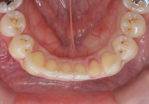 下の前歯が欠けている セラミックで審美的に エアフローで着色除去もの治療中
