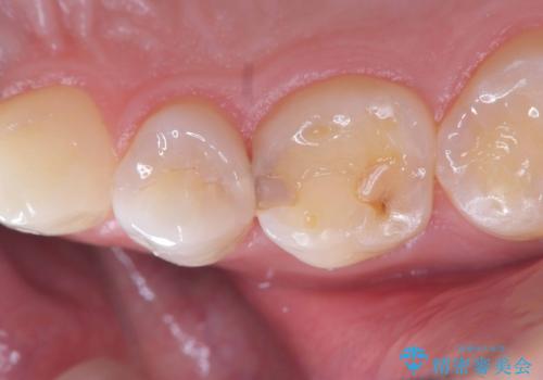 【セラミックインレー】神経の近くまで達する深い虫歯!の症例 治療前