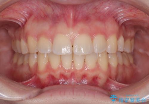 左上の前歯が出ているのが気になる 審美装置による非抜歯ワイヤー矯正