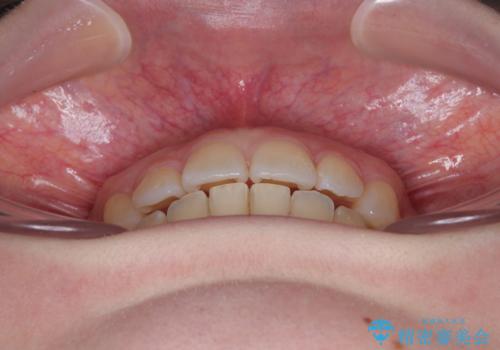 左上の前歯が出ているのが気になる 審美装置による非抜歯ワイヤー矯正の治療後