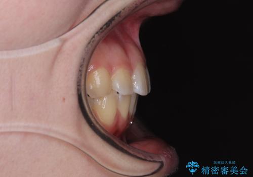 左上の前歯が出ているのが気になる 審美装置による非抜歯ワイヤー矯正の治療後