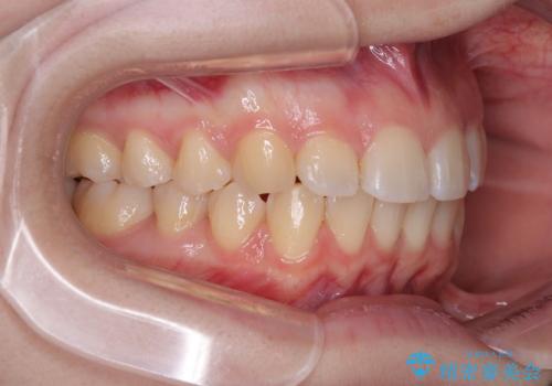 左上の前歯が出ているのが気になる 審美装置による非抜歯ワイヤー矯正の治療後