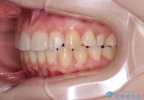 左上の前歯が出ているのが気になる 審美装置による非抜歯ワイヤー矯正の治療後