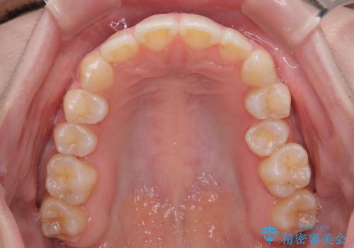 左上の前歯が出ているのが気になる 審美装置による非抜歯ワイヤー矯正の治療後