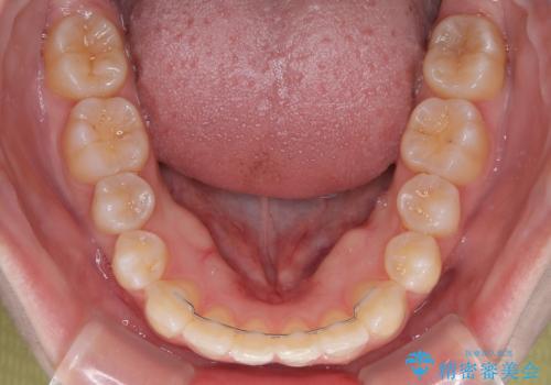 左上の前歯が出ているのが気になる 審美装置による非抜歯ワイヤー矯正の治療後