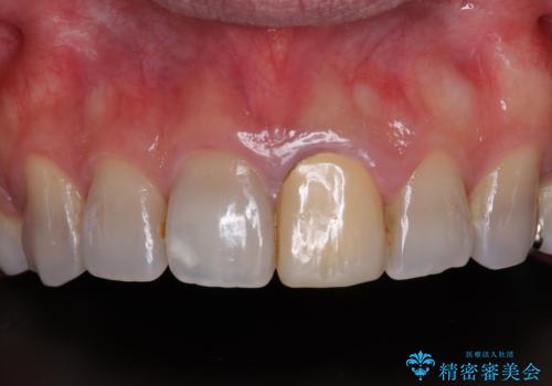 薬剤の影響で変色した歯を自然に オールセラミッククラウンによる審美歯科治療の症例 治療前