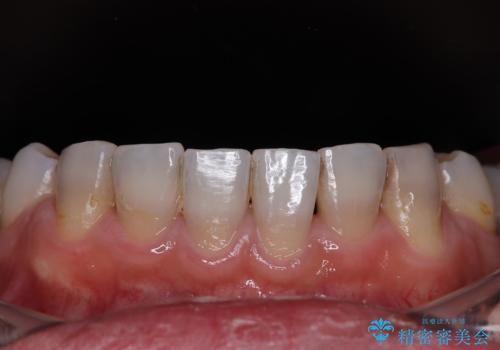 薬剤の影響で変色した歯を自然に オールセラミッククラウンによる審美歯科治療の治療前