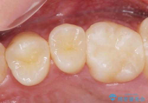 コンタクトカリエス治療。の治療後