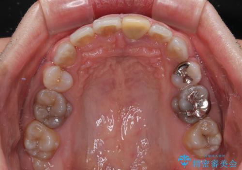 薬剤の影響で変色した歯を自然に オールセラミッククラウンによる審美歯科治療の治療前