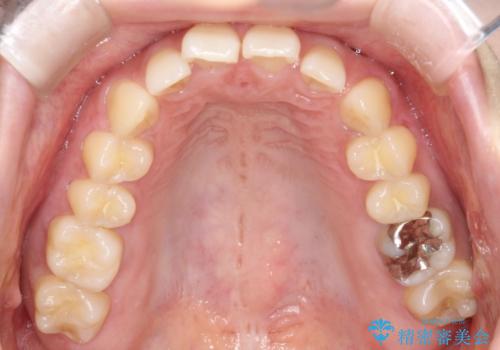 前歯の悩みを非抜歯ワイヤー矯正で改善の治療前