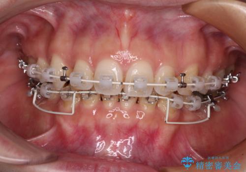 顎先に梅干し皺ができる 閉じにくい唇を抜歯矯正で閉じやすくの治療中