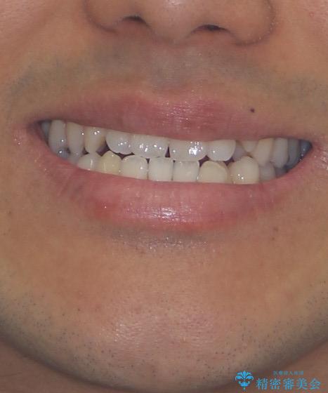 急速拡大装置 歯列弓を拡大して非抜歯ワイヤー矯正の治療前(顔貌)