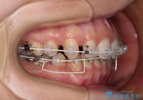 顎先に梅干し皺ができる　閉じにくい唇を抜歯矯正で閉じやすくの治療中