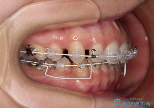 顎先に梅干し皺ができる 閉じにくい唇を抜歯矯正で閉じやすくの治療中