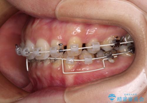 顎先に梅干し皺ができる 閉じにくい唇を抜歯矯正で閉じやすくの治療中