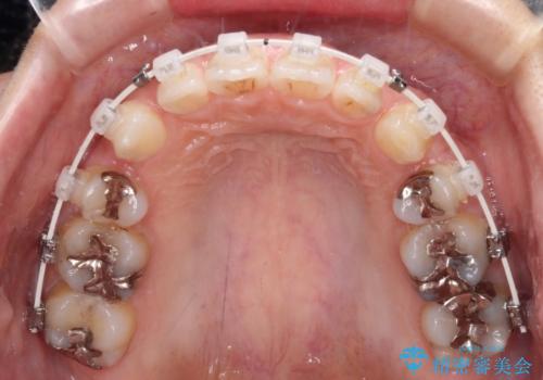 顎先に梅干し皺ができる 閉じにくい唇を抜歯矯正で閉じやすくの治療中