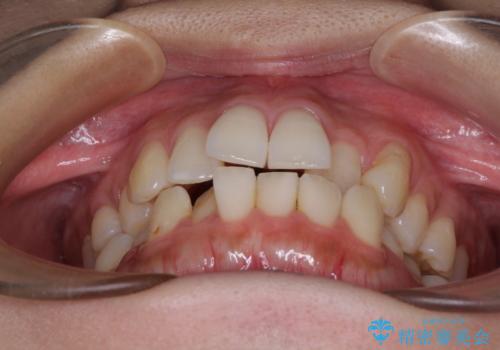 急速拡大装置 狭い歯列を拡大してワイヤー装置で短期間治療の治療前