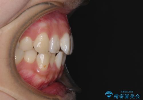 急速拡大装置 狭い歯列を拡大してワイヤー装置で短期間治療の治療前