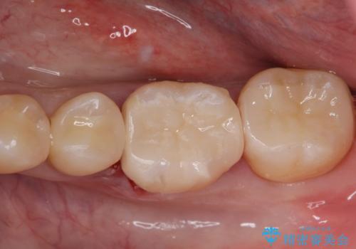 詰め物の治療。の症例 治療後