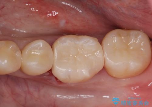 詰め物の治療。の治療後